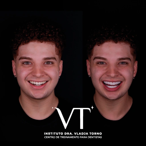 É possível fazer a troca de facetas em porcelana por facetas em resina?
